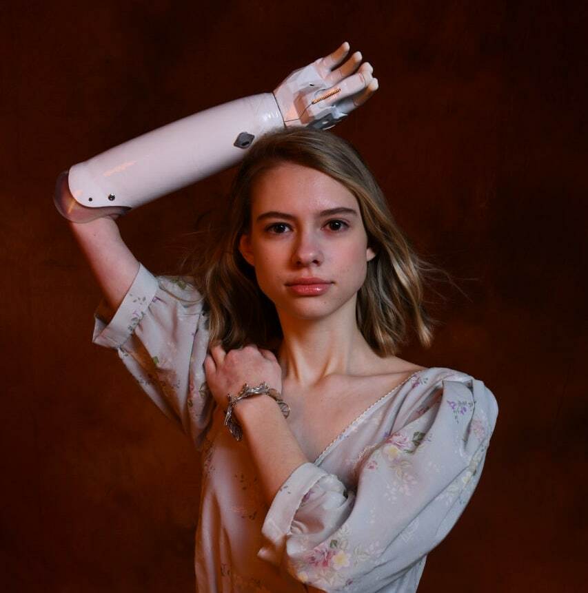 «Ей еще только предстоит осознать "Я могу все" с помощью протеза»